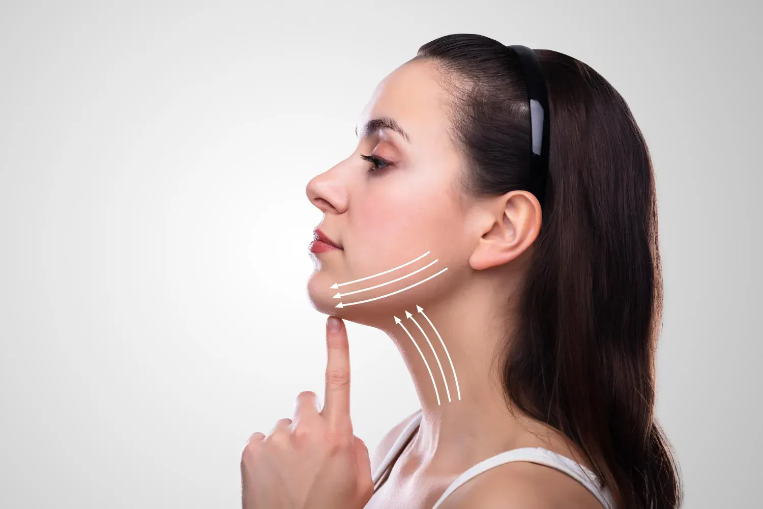 Illustration showing areas for cheek filler injections for volume and contouring in London