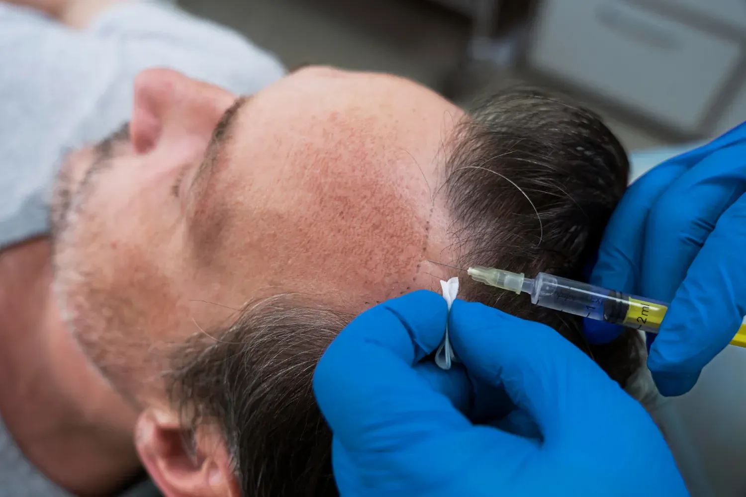 Illustration showing combination of PRP and Exosomes therapy for enhanced hair loss treatment in London