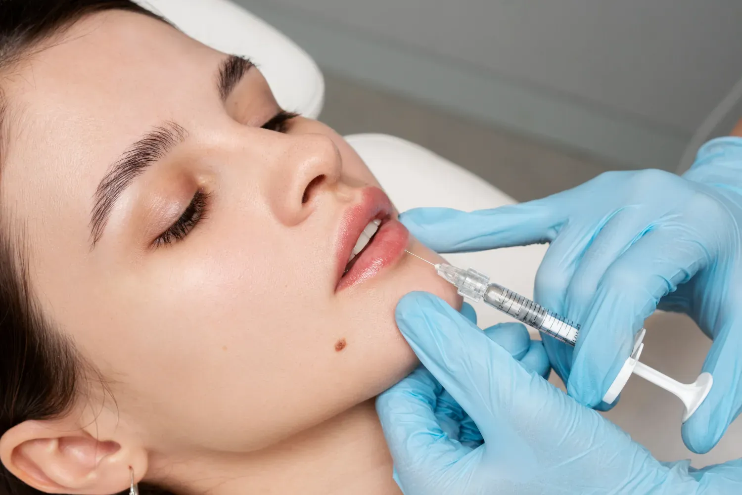 Close-up of lips before and after natural-looking lip filler treatment in London