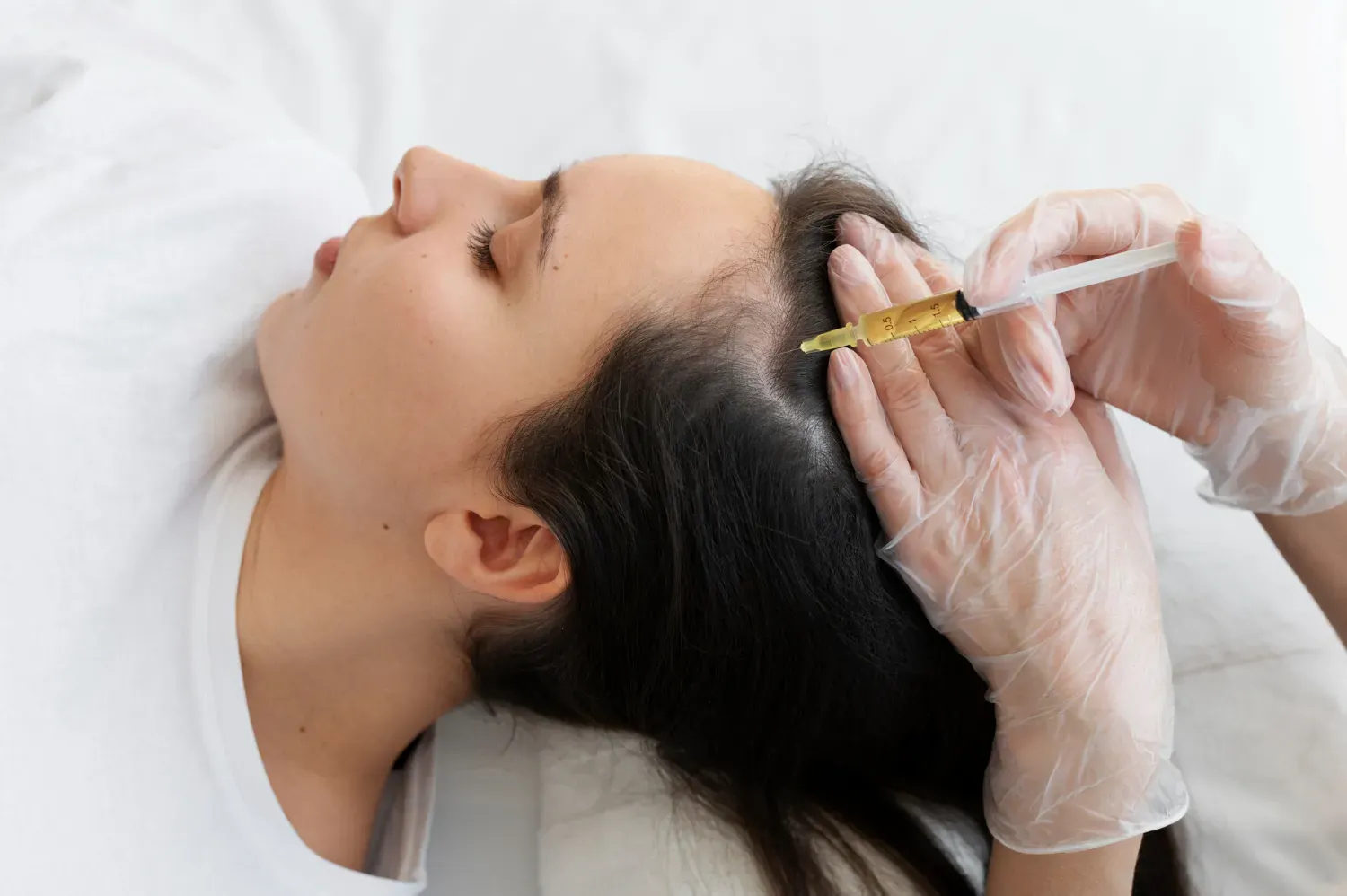 Illustration of mesotherapy micro-injections being applied to the scalp in London