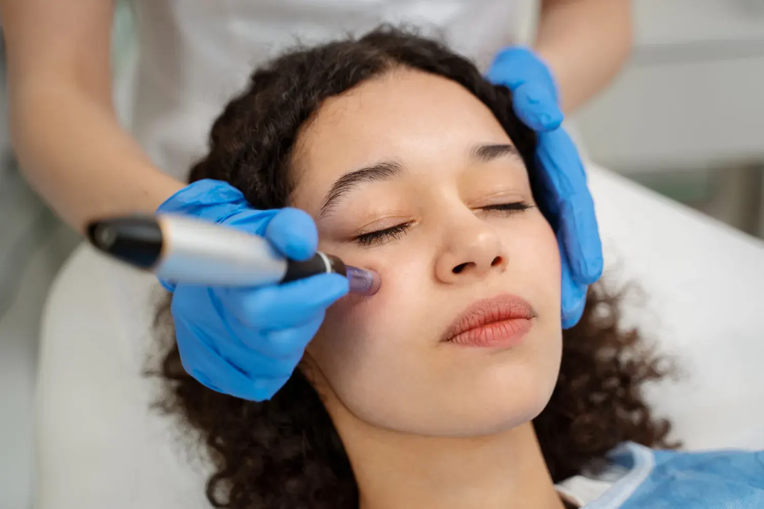 Close-up of microneedling device being used on facial skin in London clinic