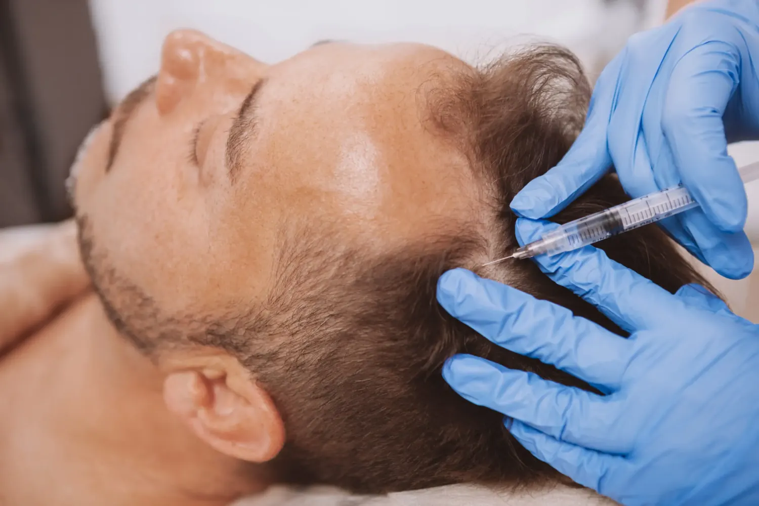 Application of PRP injections into the scalp for hair loss treatment in London