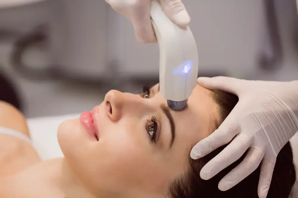 Illustration showing RF Microneedling device working on skin layers in London
